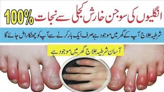 Winter Hands amp Feet Swelling Treatment Chilblainsسردیوں میں ہاتھوں پاؤں کا سوج جانے کا علاج [upl. by Enoved]