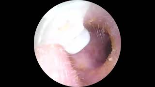 How is my Ear in the Dry weather [upl. by Anoyi]