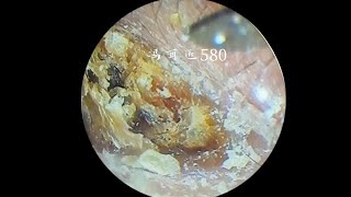 Fungal cerumen embolism dry patches on the eardrum [upl. by Epoillac]