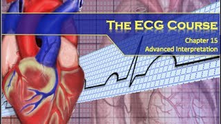 Th ECG Course  Advanced Findings [upl. by Nosremaj982]