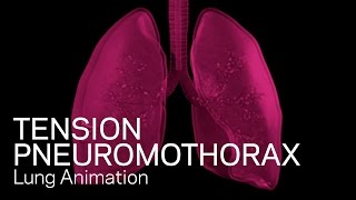 Tension Pneumothorax  Medical Animation [upl. by Erikson]