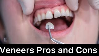 “Don’t get Veneers without watching this “ [upl. by Anderer]