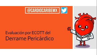 Derrame Pericárdico  Evaluación Ecocardiográfica [upl. by Eillam274]