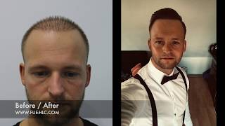 Hair Transplant Before and after Repair with 4300 Grafts  Unbelievable Result [upl. by Ademla165]