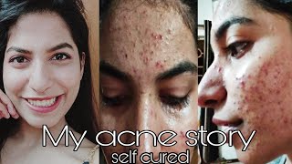 My pimple story Part 1 treatment and causes  How to reduce pimples and pimple scars  Acne [upl. by Atinauq]