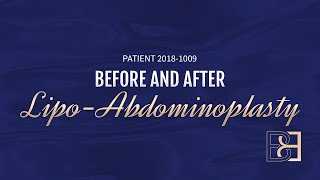 Abdominoplasty Post Pregnancy Patient 20181009 Before amp After [upl. by Addia]