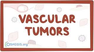 Vascular tumors kaposi hemangioma angiosarcoma  causes amp symptoms [upl. by Eitsirhc]