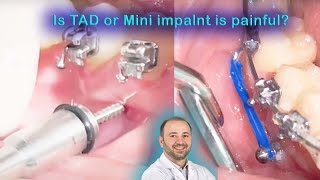 Patient feelings after tads insertion amp 1 week later screwing in ortho miniimplantes miniscrew [upl. by Brownley]