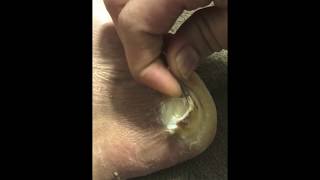 Plantar Wart removal With DuckTape and CompoundW [upl. by Ahsiemak]