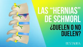 Los nódulos o hernias de Schmorl ¿Duelen o no duelen HERNIAS DE SCHMORL [upl. by Eserahc]