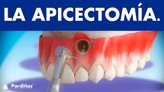 Apicectomía  Tratamiento infección de la raíz del diente © [upl. by Araik396]