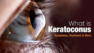 What is Keratoconus  Symptoms Treatment and More [upl. by Ellehcin335]