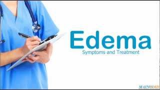 Edema Symptoms and Treatment [upl. by Maridel142]