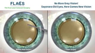 FLACS Femtosecond Laser Assisted Cataract Surgery [upl. by Derag]