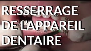 Resserrage de lappareil dentaire  Appareildentaireinfo [upl. by Elton687]