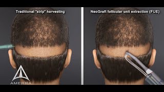 NeoGraft hair transplant procedure  animation [upl. by Kcin]