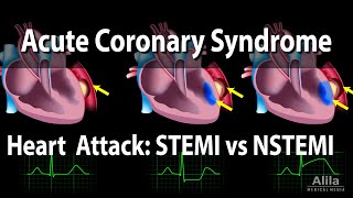 Acute Coronary Syndrome Unstable Angina NSTEMI and STEMI Heart Attack Animation [upl. by Ennayk]