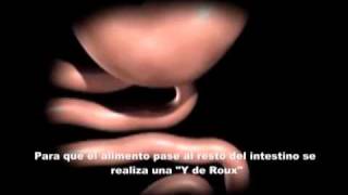 Bypass gastrico laparoscopico 2wmv [upl. by Sac]