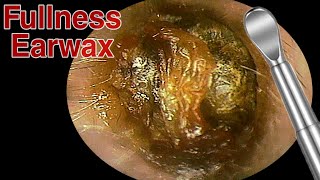 BIGGEST Ear Wax Difficult Removal  EP3  Doctor Anh [upl. by Elora]