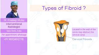 Symptoms of fibroids and various treatment options [upl. by Meek]