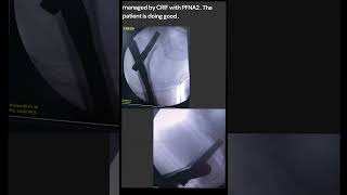 Intertrochanteric Fractures are common extracapsular fractures of the proximal femur fracture [upl. by Ahset]