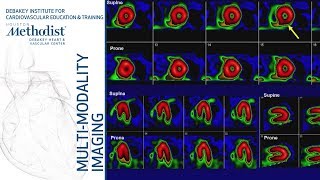 Nuclear Cardiology Understanding the Basics John J Mahmarian MD October 16 2018 [upl. by Donata770]