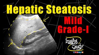 Mild Hepatic Steatosis  Mild Fatty Infiltration  Ultrasound  Case 170 [upl. by Thanh]