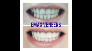 My EMAX Veneers journey [upl. by Ynor]