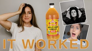 30 DAY CHALLENGE  Apple Cider Vinegar Hair Rinse  SHOCKED [upl. by Eastlake]