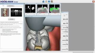 Cavity Preparation with VoxelMan Dental [upl. by Heti]