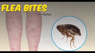 Flea Bites Everything you Need to Know [upl. by Balfour]