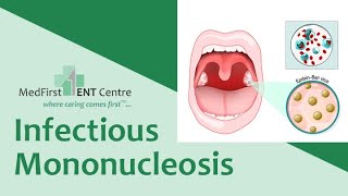 INFECTIOUS MONONUCLEOSIS  GLANDULAR FEVER MONO drrajeshbhardwaj sorethroat Tonsillitis [upl. by Calva]