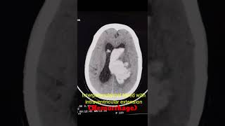 Brain Hemorrhage ct scan radiology shortvideo Head [upl. by Jezreel]