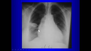 Abnormalities on Thoracic Radiography for Medical Students [upl. by Schiff296]