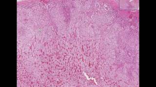 Histopathology AdrenalNodular hyperplasia [upl. by Esya617]