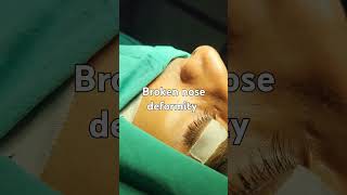 broken nose Crooked nose deformity drsuniltanvar rhinoplasty nosesurgery dns [upl. by Nairrot]