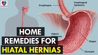 Home Remedies for Hiatal Hernias  Health Sutra [upl. by Kerrie263]