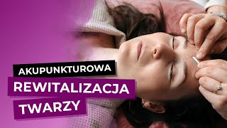 Akupunkturowa Rewitalizacja Twarzy Czym Jest Akupunktura Kosmetyczna [upl. by Gilmore]