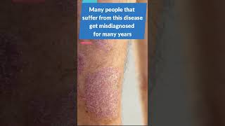 Can Psoriasis cause Arthritis Learn about Psoriatic Arthritis [upl. by Ahsetan]