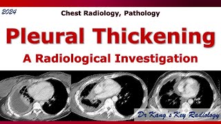 Pleural Thickening A Radiological Investigation [upl. by Ekyt]