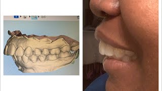 Smile Direct Overbite 3 month update I highly suggest SmileDirectClub [upl. by Waldemar336]