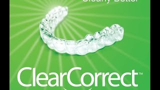 Clear Aligner Treatment with ClearCorrect™ [upl. by Latsyrk205]