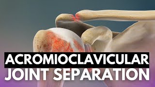 Acromioclavicular Joint Separation Navigating Symptoms and Treatment [upl. by Philips979]