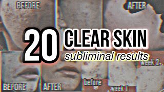 TOP 20 EXTREME CLEAR SKIN Subliminal Results ❗ [upl. by Havelock]