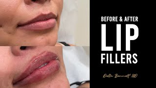 Juvederm Ultra Plus XC The Best Natural Looking Lip Filler by Christina RN 004 [upl. by Aidnama]