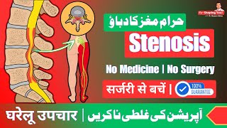 Spinal Stenosis  Reasons amp Best Treatment  Home Exercises  UrduHindi [upl. by Pepi28]