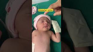 Reflex examination physiology  palmar reflex in newborn  Glabellar reflex in newborn  youtube [upl. by Edmea]