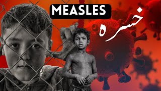 Measles Symptoms  Causes  Diagnosis  Treatment  khasra ka ilaj in urduhindi [upl. by Semaj]