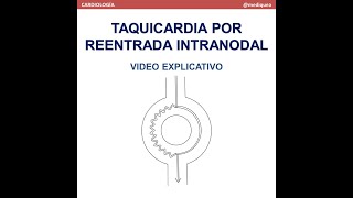 Taquicardia por Reentrada Intranodal TRIN Video explicativo [upl. by Yeznil]