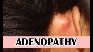 Lumps behind ear swollen glands Adenopathy [upl. by Acul]